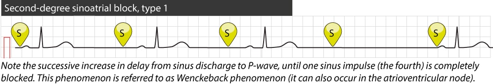 Figure 2. Type 1 second-degree sinoatrial block.