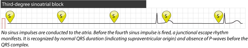 Figure 4. Third-degree sinoatrial block.