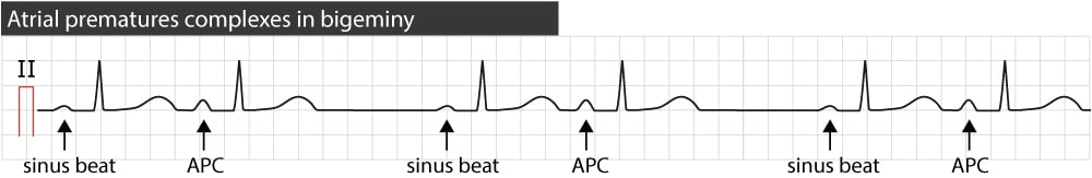 Figure 6. Atrial premature contractions in bigeminy.