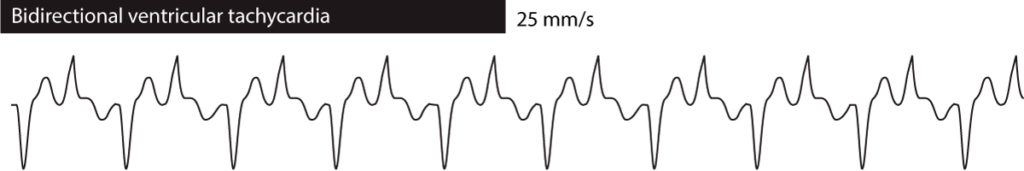 Figure 3. Bidirectional ventricular tachycardia.