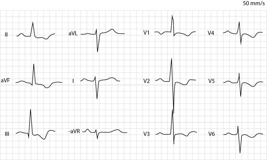Figure 2. Right ventricular hypertrophy.