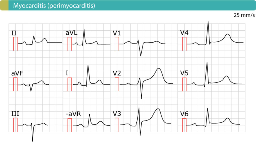 Figure 8. Perimyocarditis (myocarditis) causes generalized ST-segment elevations.