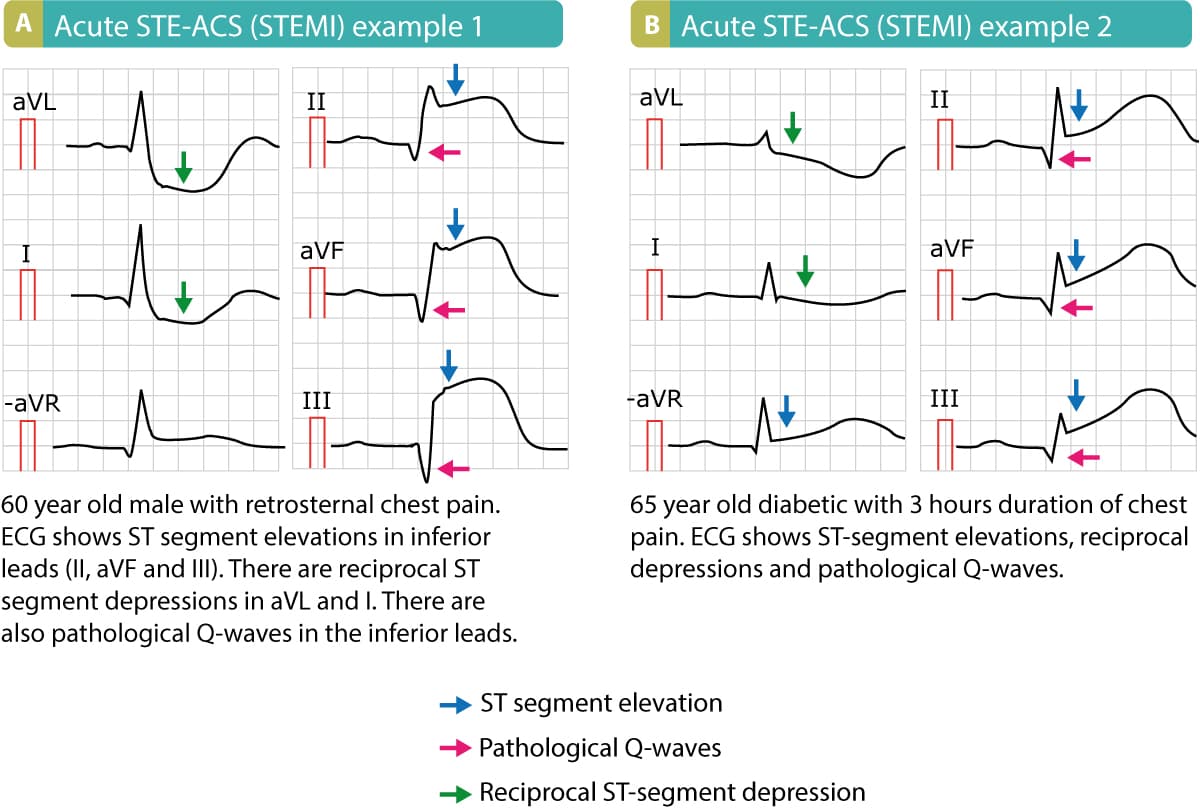 Illustration ur kursen Klinisk EKG-tolkning