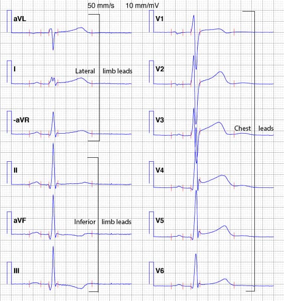 Illustration ur kursen Det normale EKG: Fra normalitet til patologi
