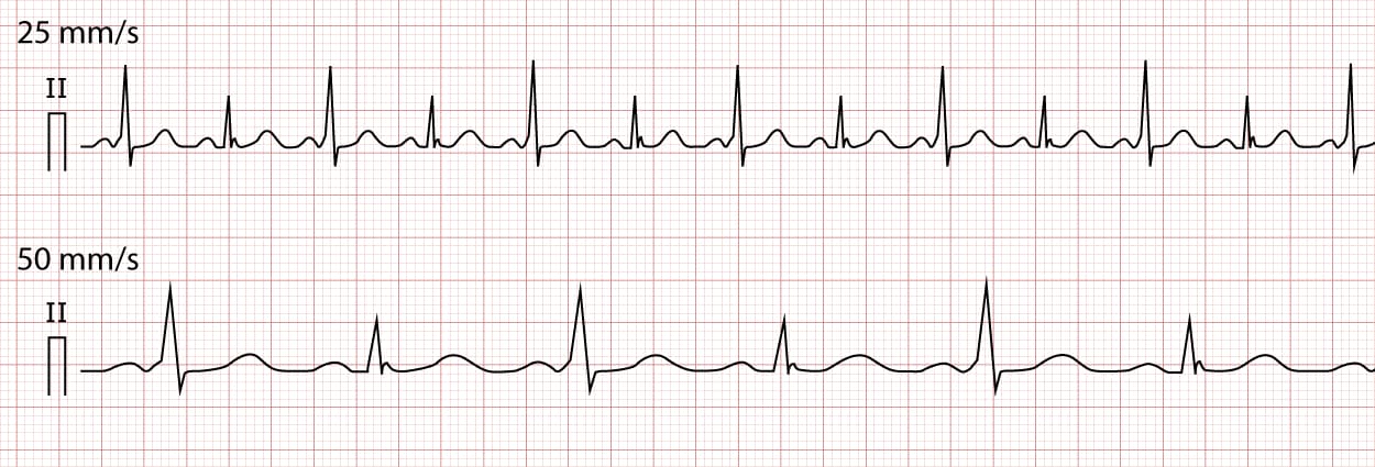 Illustration ur kursen EKG-tester (Quiz)