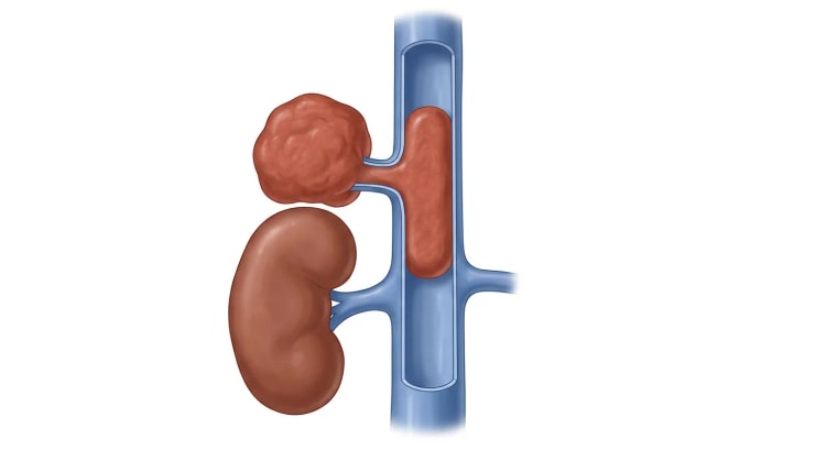 Tegnet frontalbilde av en knudrete tumor over høyre nyres øvre pol, forbundet med vena cava inferior via en kort binyrevene. Karets fremre vegg er fjernet slik at en solid tumorplugg ses inne i lumen, med åpent karlumen over og under pluggen.