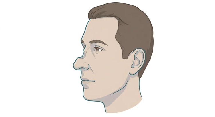 Hode i sideprofil hos en middelaldrende voksen der midtpartiet av neseryggen er innsunket, slik at profillinjen danner en tydelig fordypning mellom neseroten og den avrundede, noe oppovervendte nesetippen.