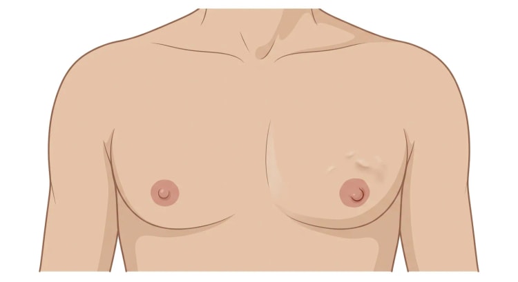 Frontalbilde av en manns brystkasse. Høyre side er normal; på venstre side finnes en uregelmessig hudinndragning ovenfor og lateralt for areola og en inndratt brystvorte.