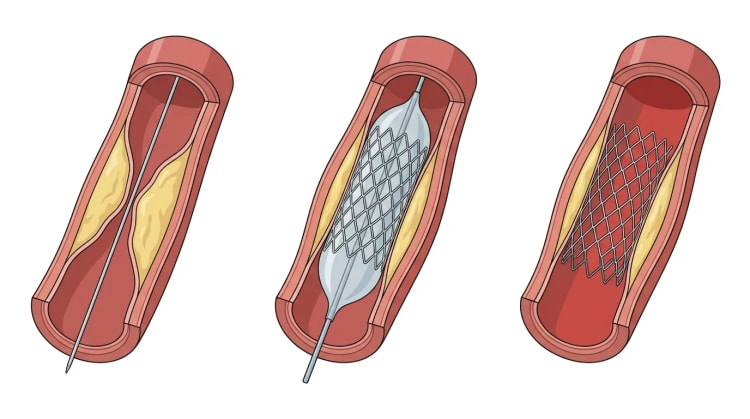 Tre oppskårne koronararteriesegmenter som viser stenose med ledevaier, oppblåst ballong med stent og gjenværende ekspandert stent.