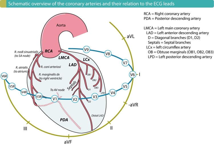 Høyre ventrikkel forsynes av høyre marginalarterie (r. marginalis dx), som utgår fra høyre koronararterie (RCA). RCA forsyner også den inferiore veggen i venstre ventrikkel hos over 90 % av befolkningen. En proksimal okklusjon i RCA som avskjærer blodtilførselen til høyre ventrikkel, vil derfor også påvirke den inferiore veggen i venstre ventrikkel i 90 % av tilfellene.