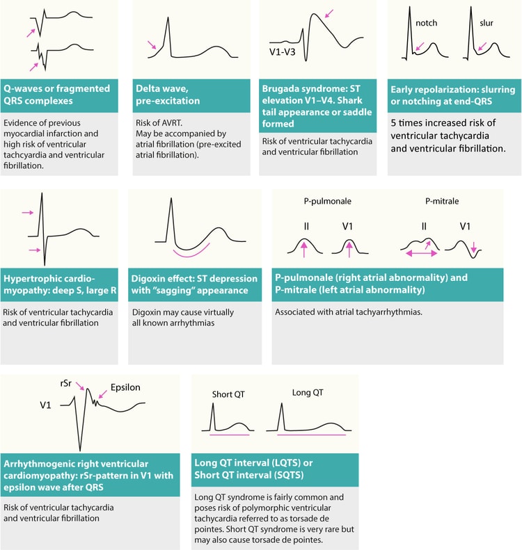 Figur 3. Forandringer på hvile-EKG som kan avsløre årsaken til arytmier (arytmisubstrater).