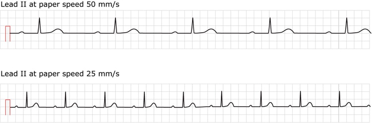 Figur 1. EKG ved førstegrads AV-blokk. Begge vanlige papirhastigheter vises.