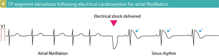 Figur 12. Elektrisk kardioversjon som resulterer i transiente ST-segmenthevninger.
