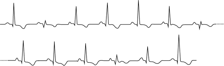 Figur 1. Elektrisk alternans hos en pasient med hjertetamponade. EKG-et viser varierende QRS- og T-bølgeamplituder.