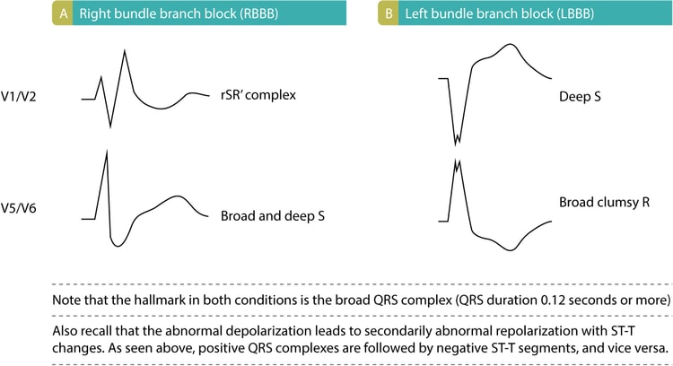 Figur 2. Kjennetegn ved grenblokk. (A): EKG-funn ved høyre grenblokk (RBBB). (B): EKG-funn ved venstre grenblokk (LBBB).