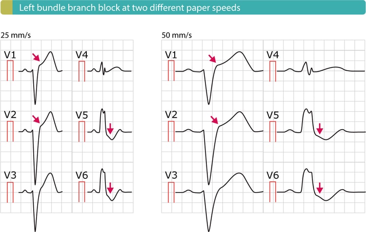 Figur 4. Venstre grenblokk (LBBB) med typiske ST-elevasjoner (V1–V2) og ST-depresjoner (V5-V6).