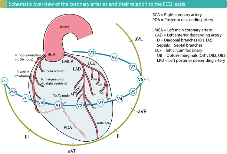 Figur 1. Koronararteriene og deres relasjon til EKG-avledningene. Lokalisering av hjerteinfarkt/iskemi gjøres ved å bruke EKG-forandringer til å bestemme det affiserte området og deretter den okkluderte koronararterien (culprit).