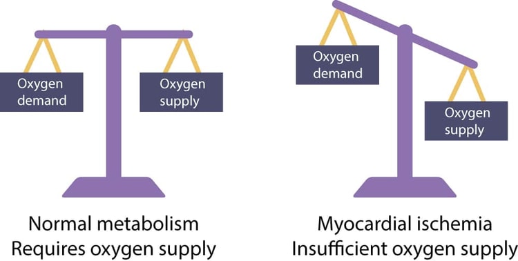 Figur 1. Myokardcellene trenger kontinuerlig oksygentilførsel for å opprettholde normal metabolisme. Hvis oksygentilførselen er mindre enn oksygenbehovet, oppstår det iskemi. Myokardcellene kan gå over til anaerob metabolisme og avbryte sammentrekningene for å lindre iskemien. Dette gjør at cellen kan holde ut opptil 30 minutter med alvorlig iskemi. Hvis blodstrømmen ikke gjenopprettes før det har gått 30 minutter, vil cellen dø. Død av myokardceller omtales som hjerteinfarkt.
