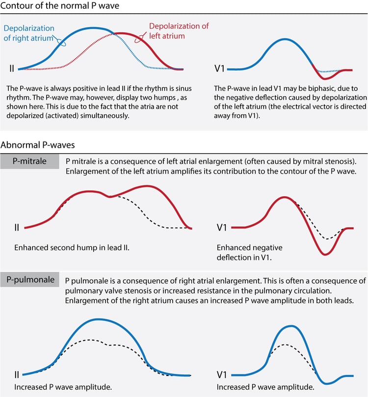 Figur 1. EKG-kontur av normal P-bølge, P mitrale (forstørrelse av venstre atrium) og P pulmonale (forstørrelse av høyre atrium). Merk endringene i både amplitude og varighet avhengig av patologi.