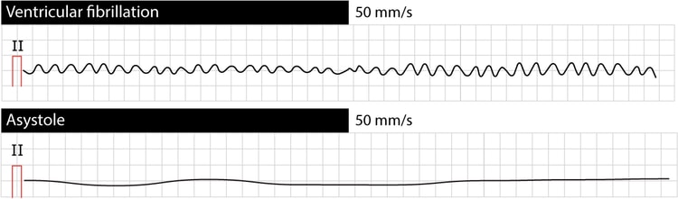 Figur 1. Ventrikkelflimmer og asystole.