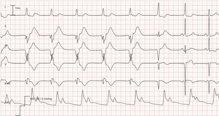 EKG-eksempel: Idioventrikulær rytme (akselerert ventrikulær rytme). Akselerert ventrikulær rytme med en frekvens på 56 i de første 5 slagene, etterfulgt av 2 fusjonsslag; de siste 2 slagene er normal sinusrytme.