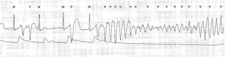 EKG som viser en episode med sinusrytme (med flere premature ventrikkelslag) som spontant går over i torsades de pointes-ventrikkeltakykardi. Legg merke til hvordan det arterielle blodtrykket (ABP) faller ved starten av TdP. EKG av Nakstad et al. (Scand J Trauma Resusc Emerg Med. 2010; 18: 7)