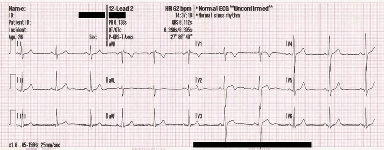 Figur 1. Tradisjonell presentasjon av avledningene i 12-avlednings-EKG.