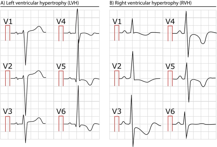 Figur 2. To EKG-er som viser venstre og høyre ventrikkelhypertrofi.
