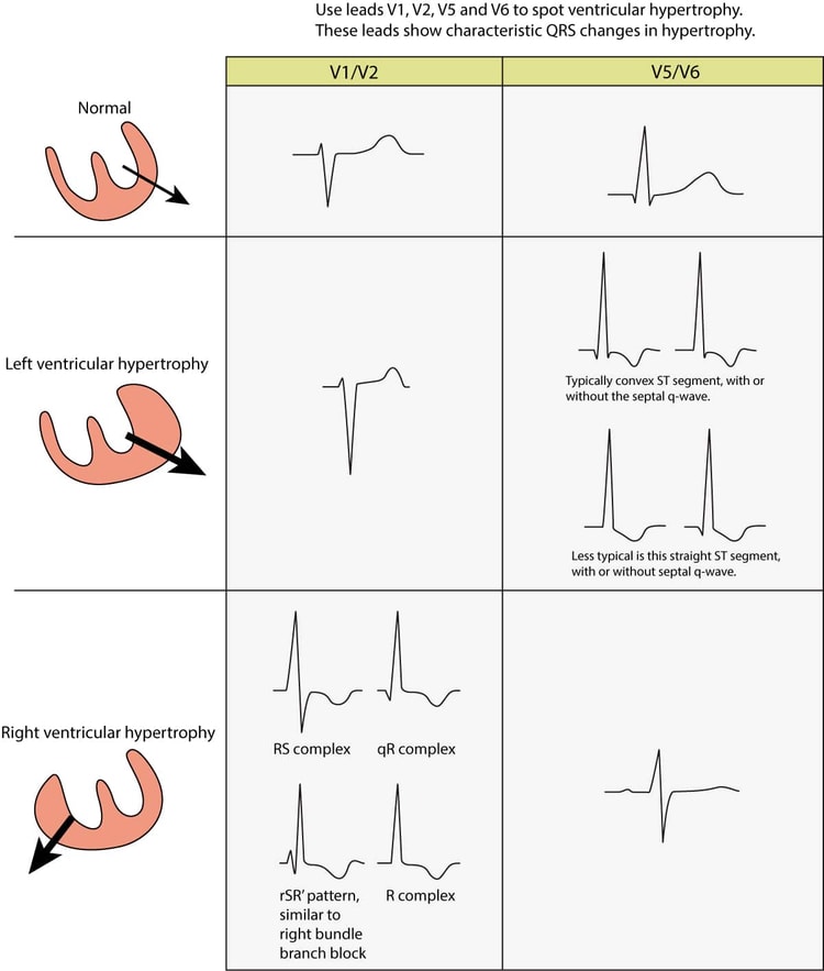 Figur 1. EKG-forandringer ved venstre ventrikkelhypertrofi (LVH) og høyre ventrikkelhypertrofi (RVH). Den elektriske vektoren i venstre ventrikkel er forsterket ved venstre ventrikkelhypertrofi, noe som resulterer i store R-bølger i venstresidige avledninger (V5, V6, aVL og I) og dype S-bølger i høyresidige brystavledninger (V1, V2). Høyre ventrikkelhypertrofi forårsaker store R-bølger i høyresidige brystavledninger og dypere S-bølger i venstresidige avledninger.