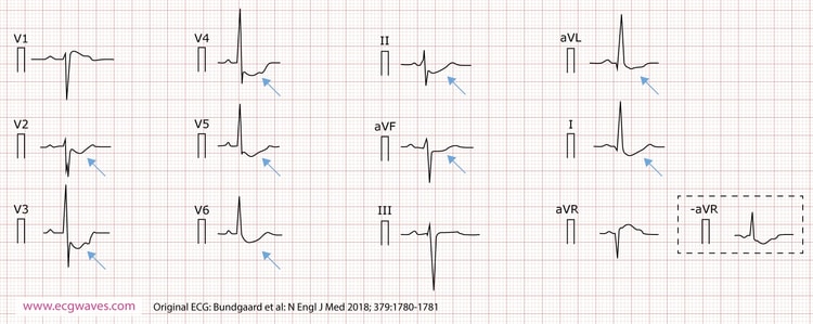 Figur 4. 12-avlednings-EKG (presentert i henhold til Cabrera), tatt ved 63 års alder, viser konkavt stigende ST-senkning i avledning I, II, aVL, aVF og V2 til V6, og ST-elevasjon i avledning aVR (som tilsvarer en identisk ST-senkning i den inverterte avledningen -aVR). Et hakk er tydelig i den stigende delen av ST-segmentet.