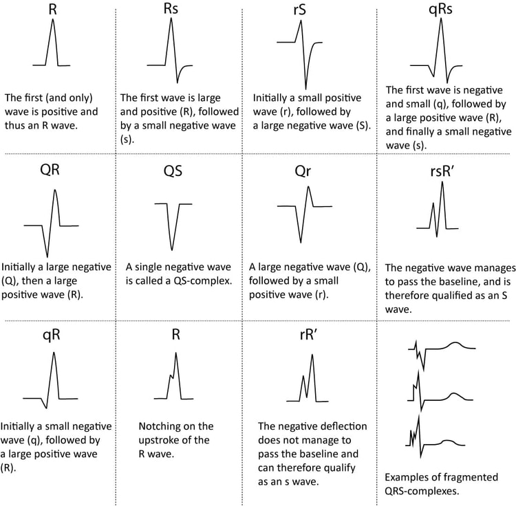 Figur 5. Navngivning av QRS-komplekset.