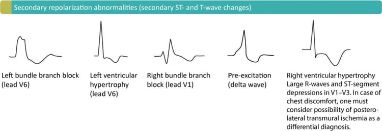 Figur 4. Sekundære ST-T-forandringer på grunn av LBBB (venstre grenblokk), LVH (venstre ventrikkelhypertrofi), RBBB (høyre grenblokk), pre-eksitasjon (WPW-syndrom) og RVH (høyre ventrikkelhypertrofi).