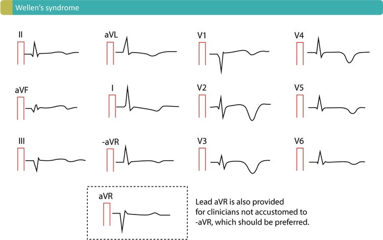 Figur 3. Karakteristiske T-bølgeinversjoner forårsaket av Wellens syndrom. Dette EKG-mønsteret omtales ofte som Wellen-tegn.