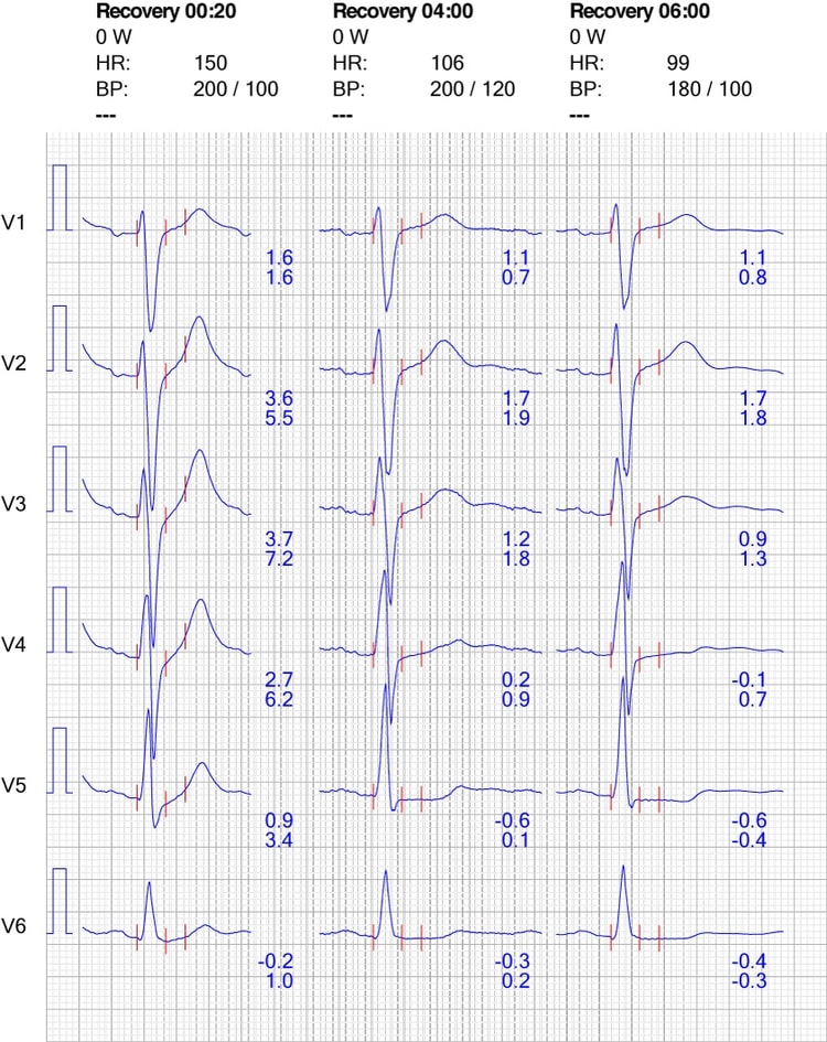 Figur 10. EKG-reaksjon i brystavledninger under restitusjon.
