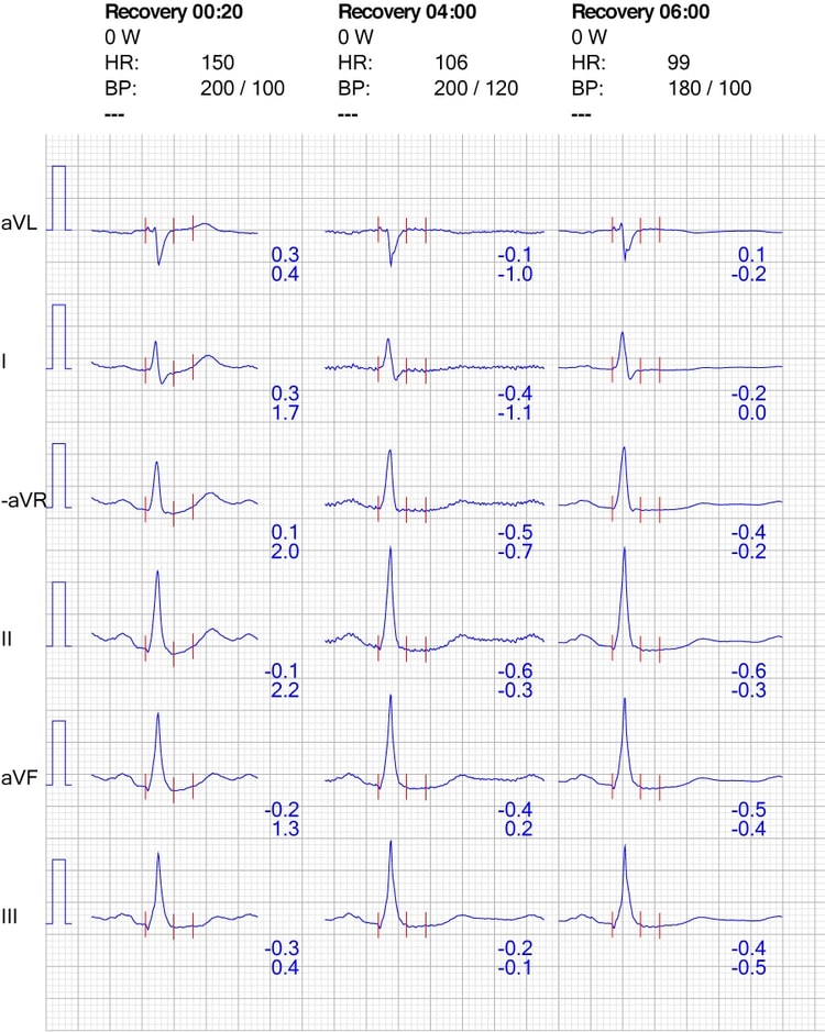 Figur 8. EKG-reaksjon i ekstremitetsavledninger under restitusjon.