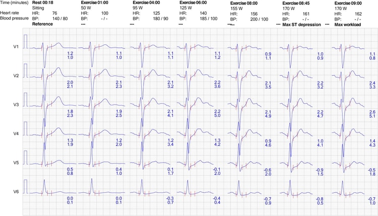Figur 9. EKG-respons i brystavledningene under belastning.