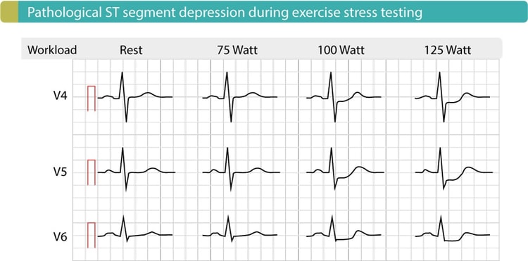 Figur 5. Anstrengelses-EKG hos en pasient med koronarsykdom viser signifikante ST-senkninger i J-60-punktet og J-80-punktet. Disse senkningene blir mer uttalte når arbeidsbelastningen øker. Denne testen ble utført på sykkel.