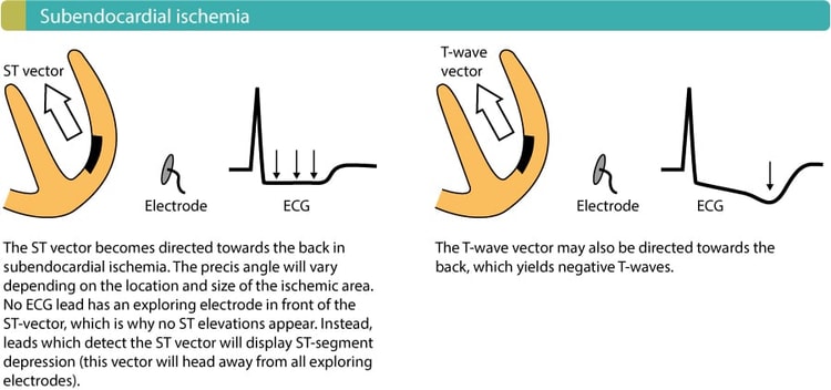 Figur 1. Anstrengelse forårsaker subendokardiell iskemi og dermed ST-segmentdepresjon på EKG.
