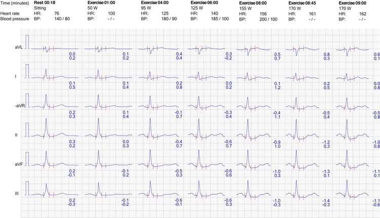 Figur 7. EKG-reaksjon i ekstremitetsavledninger under trening.
