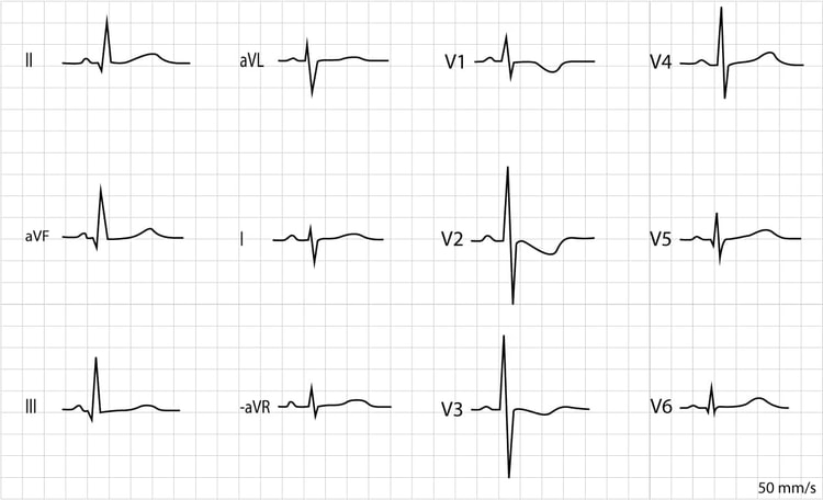 Figur 3. EKG registrert hos en 8 dager gammel jente. Den elektriske aksen er høyredeviert (negativt QRS i avledning I og positivt QRS i avledning II). R-bølgene er fremtredende i avledning V1, V2 og V3. Det er negative T-bølger i V1–V3, noe som også er normalt. Det er Q-bølger i inferiore ekstremitetsavledninger (II, aVF og III) og laterale brystavledninger (V5, V6).