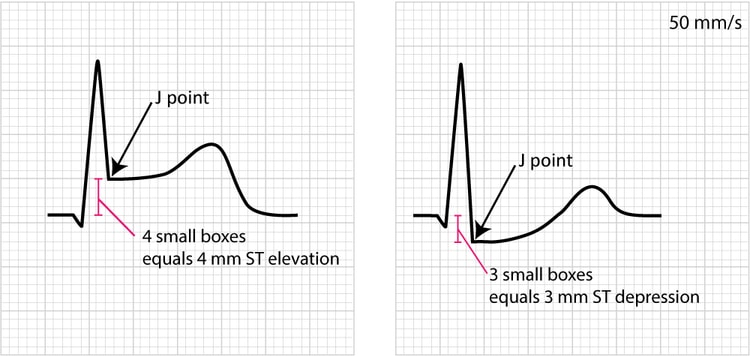 Figur 2. Eksempler på måling av ST-elevasjon og ST-depresjon. Myokardisk iskemi er svært sannsynlig hvis disse EKG-forandringene ledsages av ubehag i brystet eller andre symptomer som tyder på iskemi.