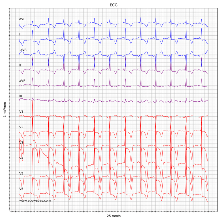 EKG ved hypertrofisk obstruktiv kardiomyopati (HCM/HOCM)