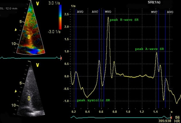 Figur 6. Måling av longitudinell deformasjonshastighet (Strain Rate) med Doppler. Y-aksen viser deformasjonshastighet (1/s), og x-aksen viser tid. Negative verdier observeres under systole (sammentrekning).