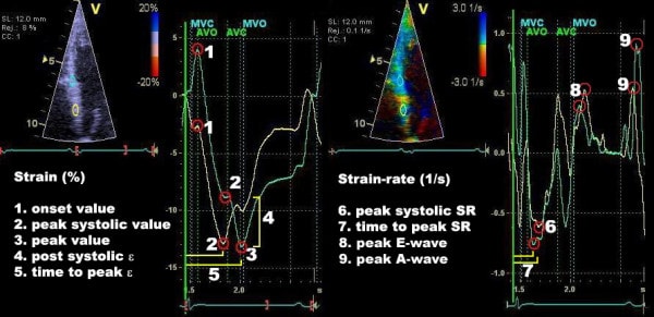 Figur 7. Parametere på strain- og strain rate-diagrammer. Begge panelene viser det samme myokardområdet, dvs. basalseptum.