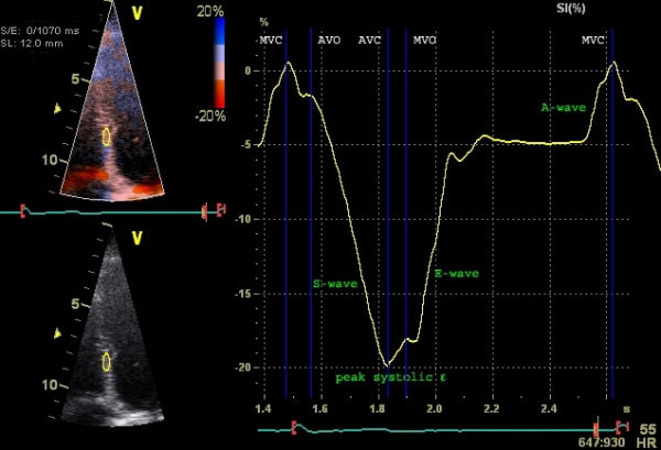 Figur 5. Undersøkelse av strain (longitudinell strain) med vevsdoppler. Septal strain undersøkes. Y-aksen viser deformasjon (% deformasjon) og x-aksen viser tid. Kurven går nedover i systolen (negativ strain).