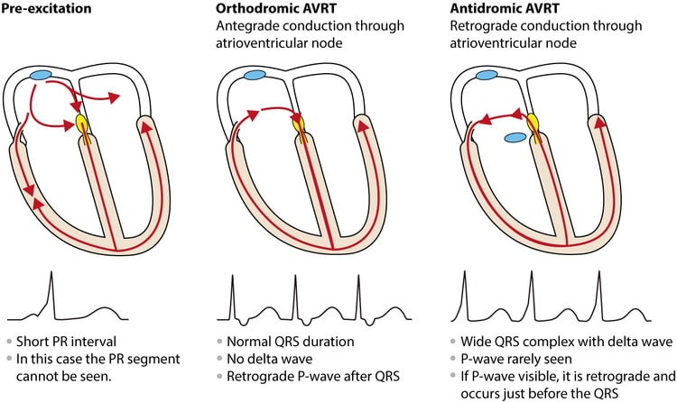 Figur 3. Antidrom og ortodrom AVRT ved WPW.