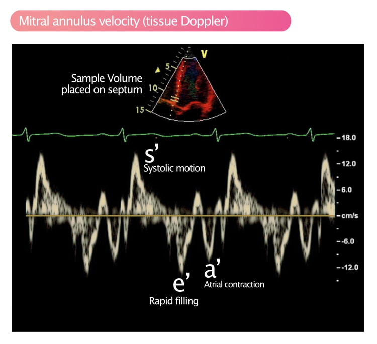 Figur 2. Pulserende vevsdoppler (PW-TDI) som analyserer bevegelser i mitralringen (lateral vegg). Den positive bølgen over grunnlinjen er den systoliske hastigheten (s'), mens bølgene under linjen representerer tidlig (e') og sen (a') diastolisk fylling.