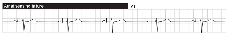 Svikt i sensing. Atriell pacing skjer etter den intrinsiske P-bølgen.