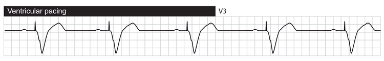 Spontan atrieaktivitet registreres av atrieelektroden og utløser ventrikkelstimulering. QRS-komplekset er bredt fordi ventrikkeldepolariseringen foregår helt eller delvis utenfor ledningssystemet.