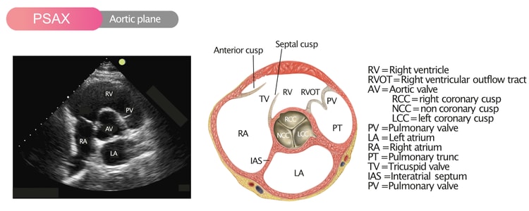 Figur 7. Parasternalt kortaksebilde (PSAX) i aortaplanet.